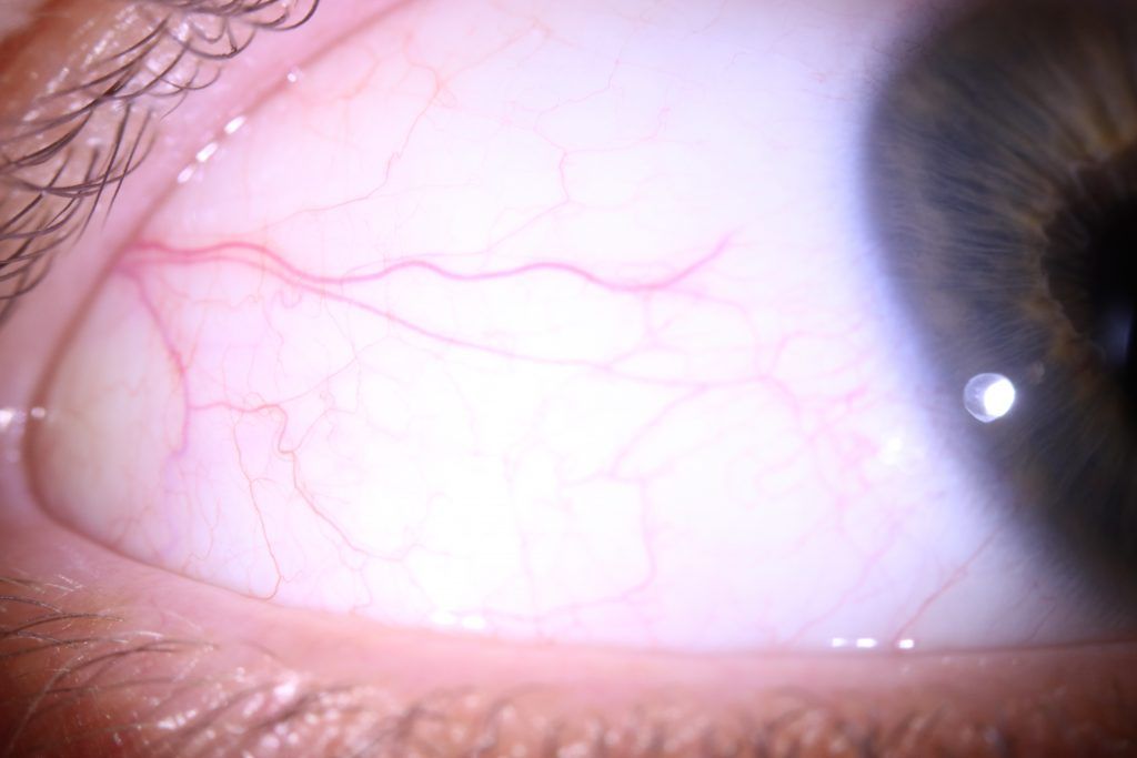 Right Eye, Lateral Sclera